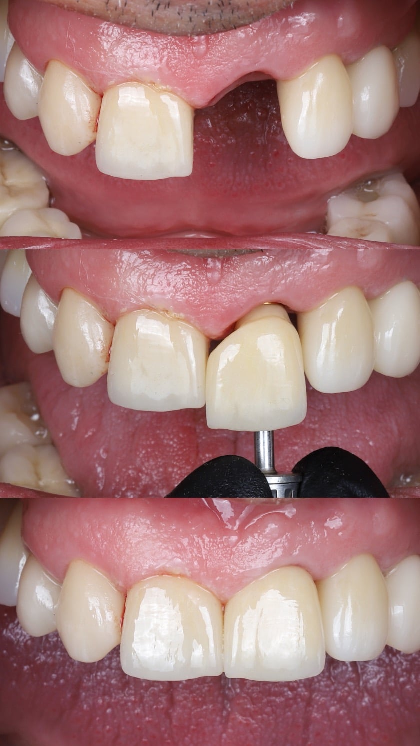 Caso de reemplazo de dientes individuales