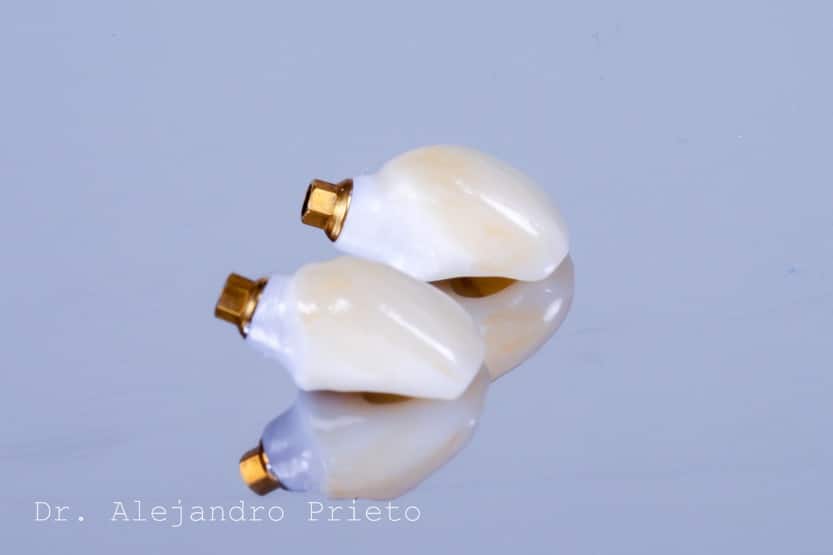 Foto de corona de zirconio para implante dental unitario