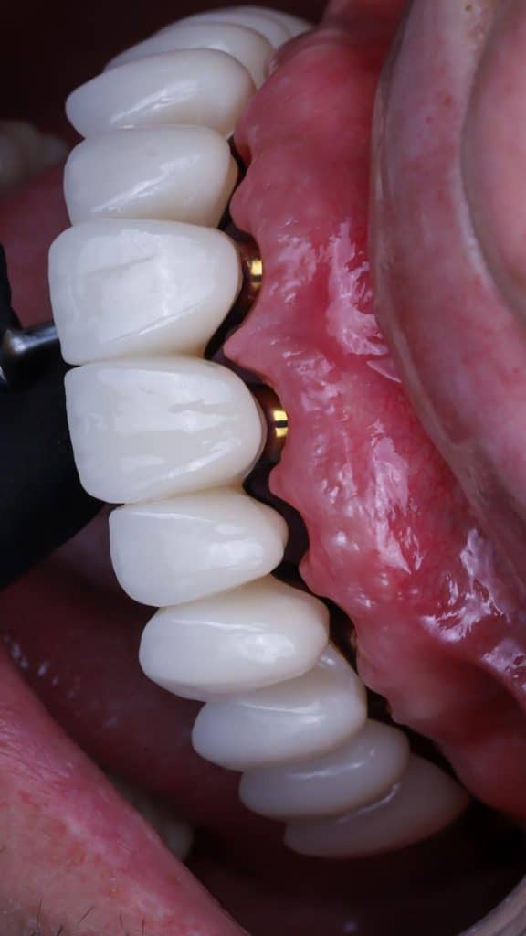 blanqueamiento dental Madrid