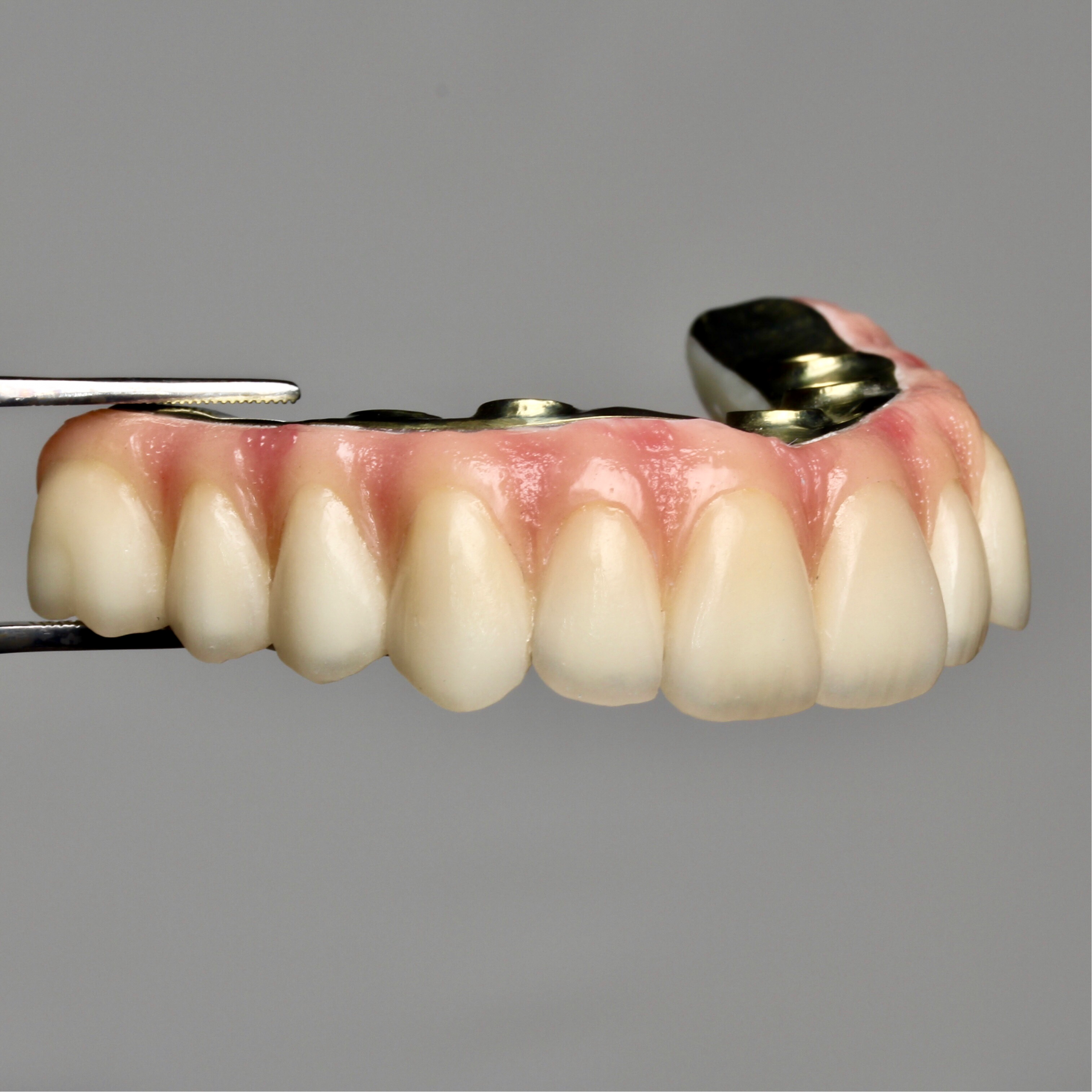Foto de carga inmediata sobre implantes en el mismo día (prótesis provisionales)