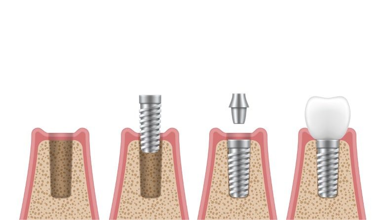 Foto de colocación de implantes dentales en dos fases