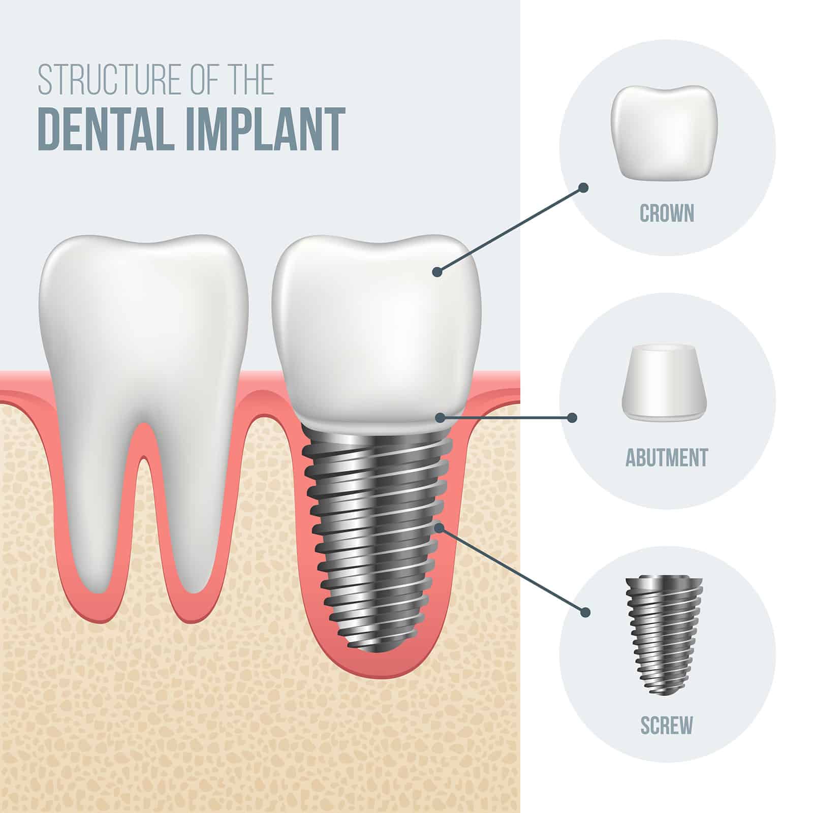 Estructura del implante dental