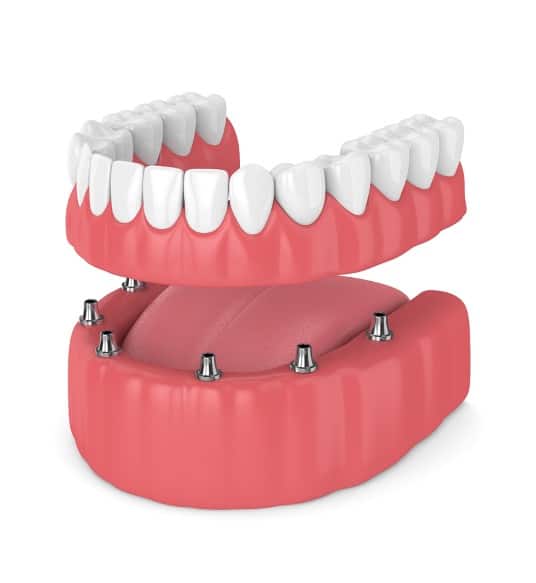 Foto de implantes all on 6