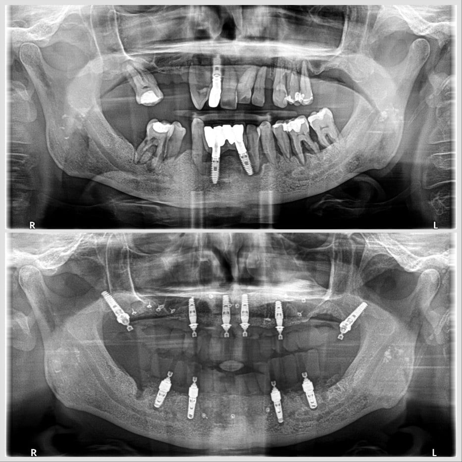 Podemos ver una foto de implantes mal colocados. Tenemos muchos casos de pacientes que vienen para que les ayudemos a re hacer tratamientos de implantes mal colocados.