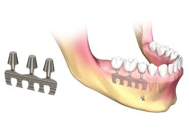 Foto de implantes laminados