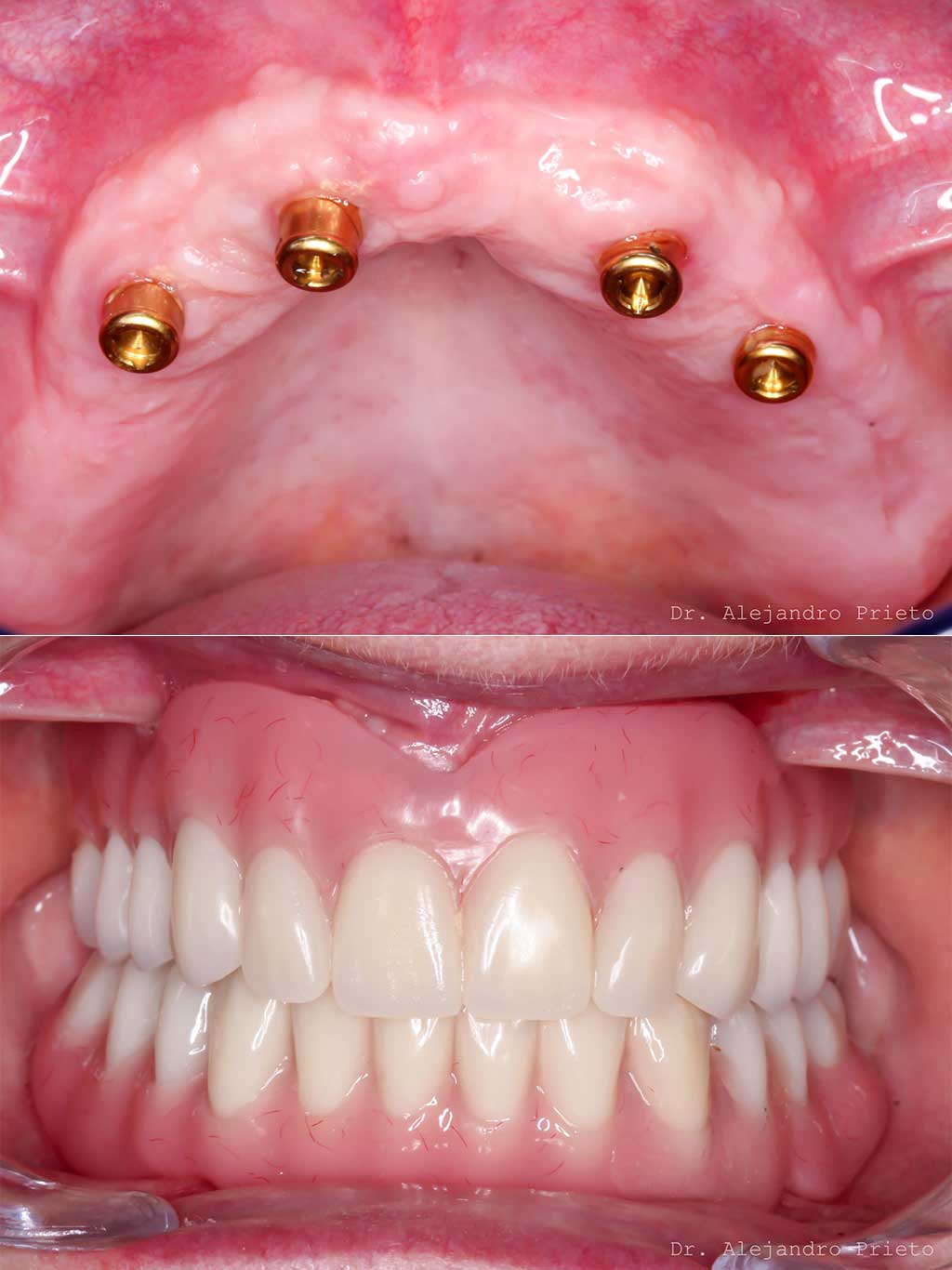 blanqueamiento dental Madrid