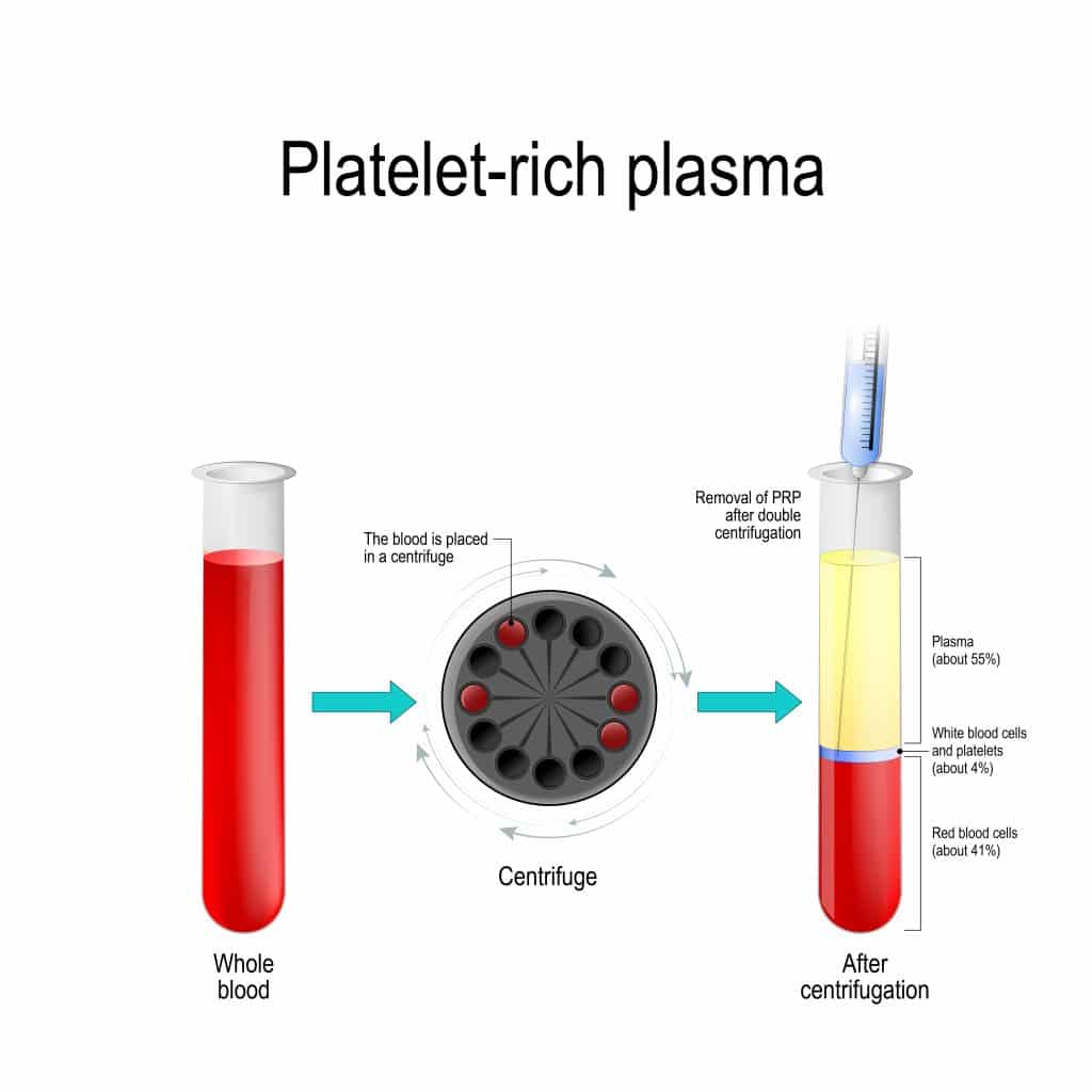 plasma rico en plaquetas para regeneración de hueso para implantes dentales