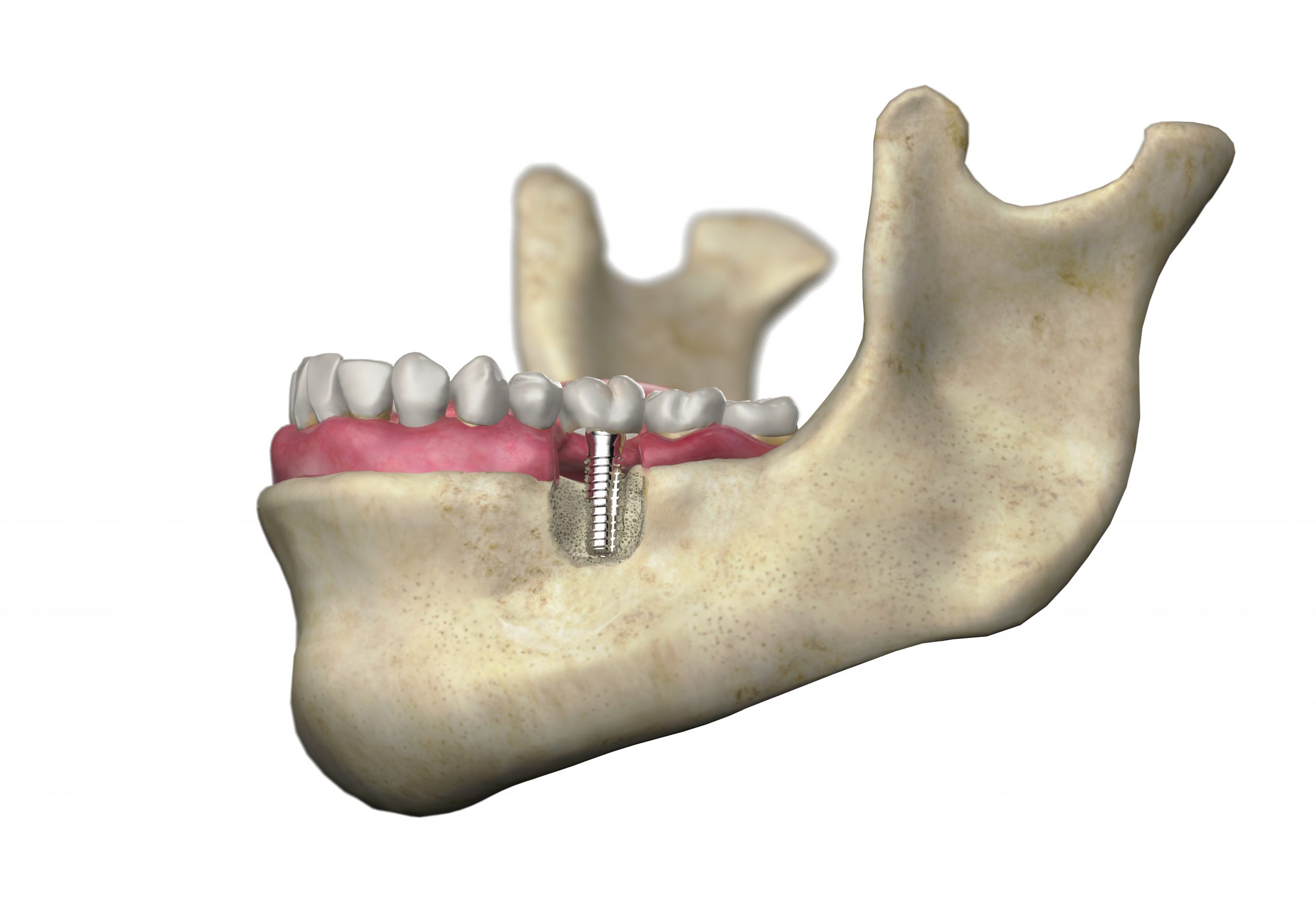 Foto de un Implante dental insertado en el hueso maxilar