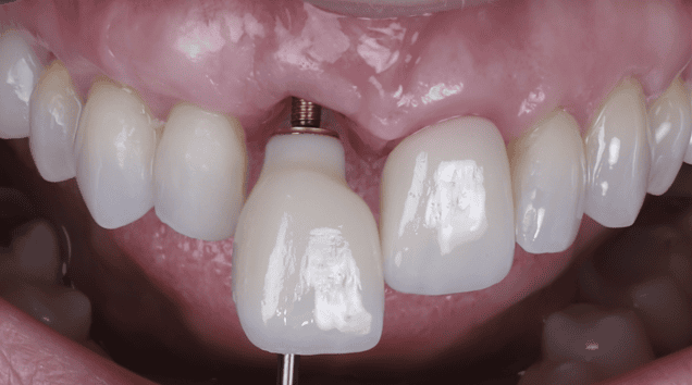 implantes dentales en madrid