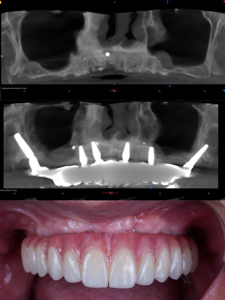 Antes y después con radiografía: prótesis fija sobre implantes pterigoideos en un maxilar atrófico, por el Dr. Alejandro Prieto en MAG Dental Madrid