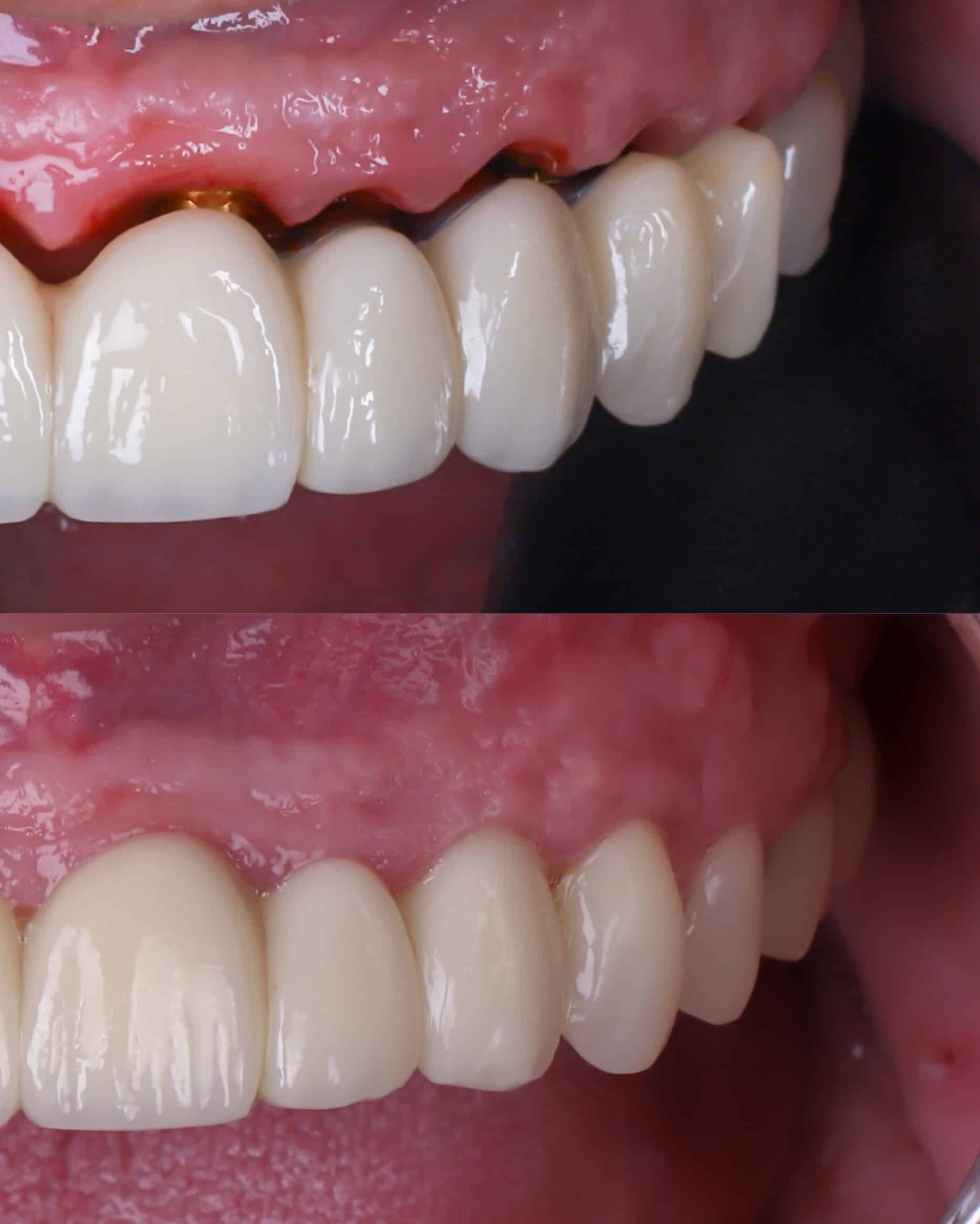 Dentadura fija sobre implantes en Madrid: prótesis fija que sale de la encía natural