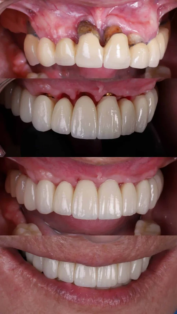 Dientes fijos sobre implantes en paciente sin hueso: antes y después en MAG Dental Madrid