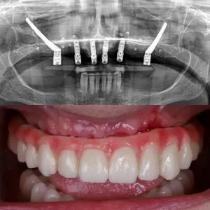 Foto de implante dental sin tornillos: estructura subperióstica para arcada completa