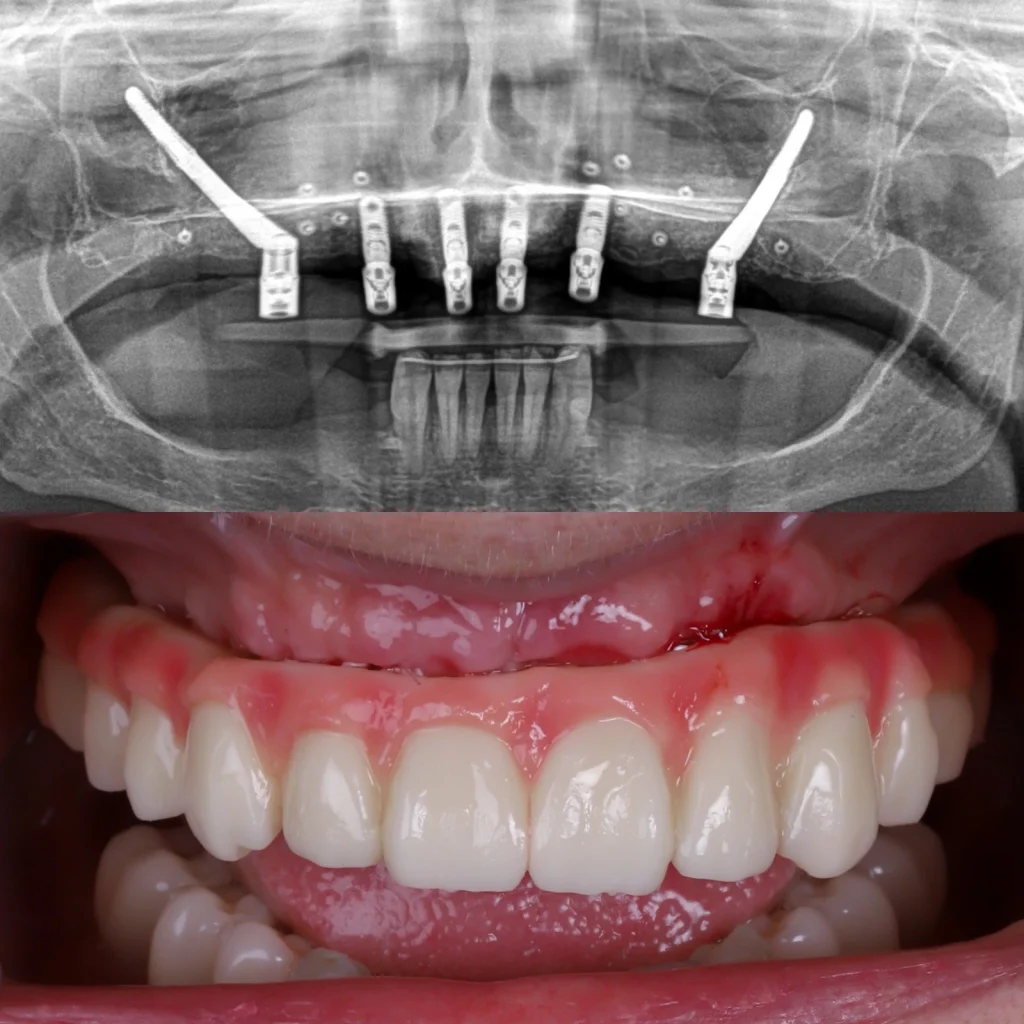 Implantes cigomáticos en paciente sin hueso: radiografía y dientes fijos, caso real de MAG Dental Madrid