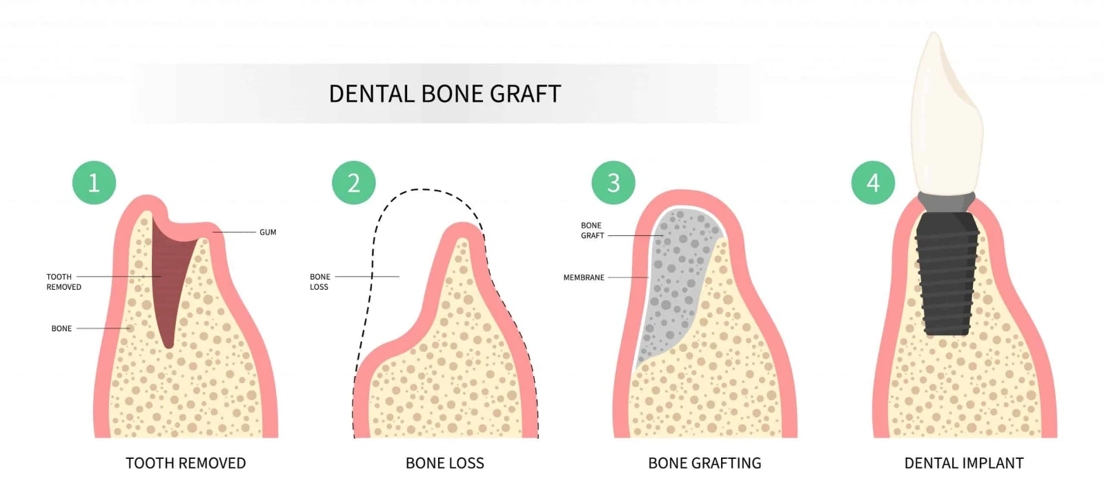 Fases del injerto de hueso para poner implantes dentales sin hueso: extracción, pérdida ósea, injerto e implante