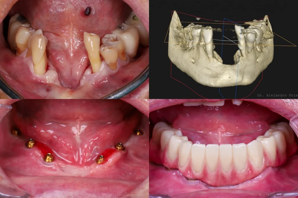 Implantes dentales sin hueso en el maxilar inferior: TAC y resultado con dientes fijos