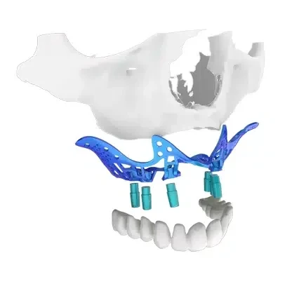 Fotos antes y después de implantes dentales sin tornillos en un paciente con falta de hueso severa