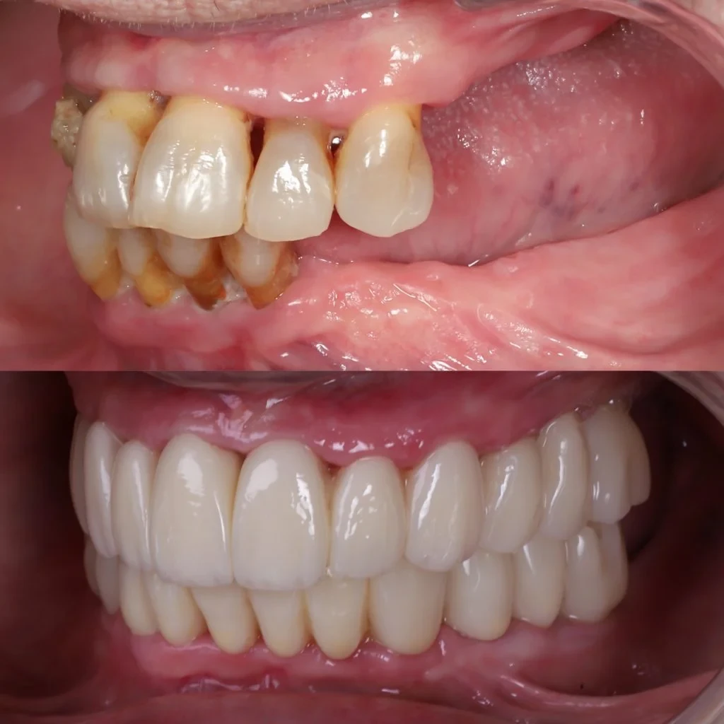 Caso real con falta severa de hueso resuelto con implantes cigomáticos en MAG Dental Madrid