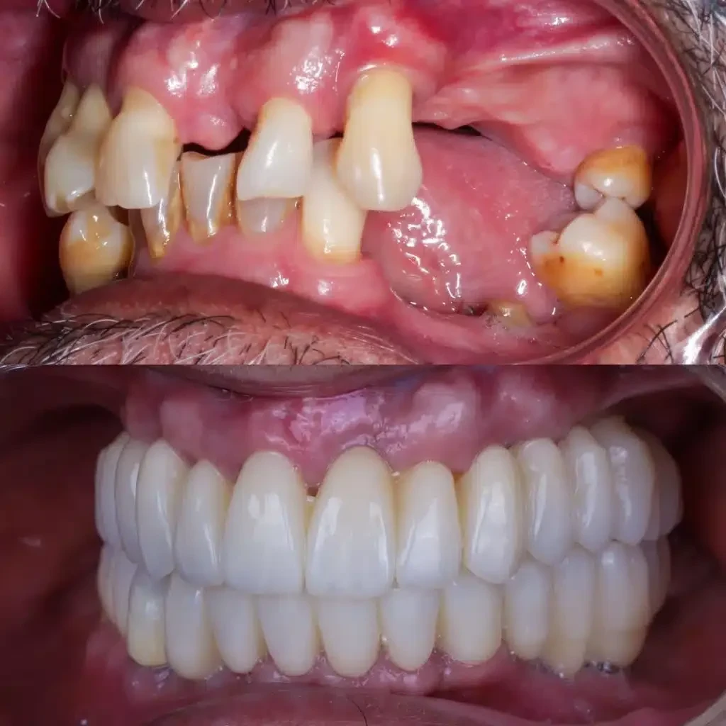 Fotos de un caso real de paciente sin hueso dental tratado en MAG Dental Madrid