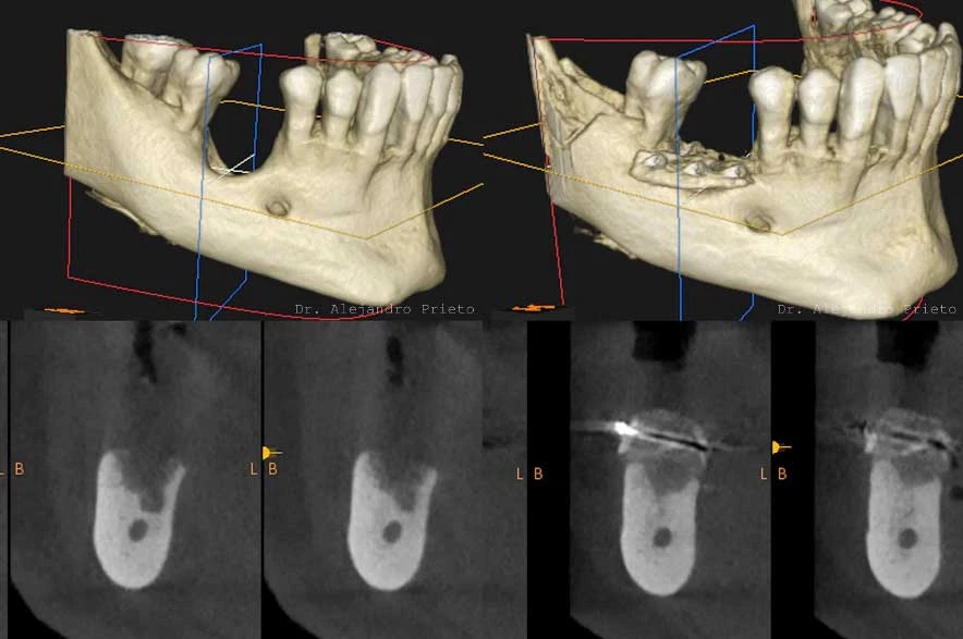 TAC 3D antes y después de un injerto de hueso autólogo en la mandíbula