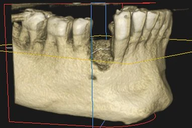 TAC 3D de una pérdida de hueso antes del injerto para implante dental