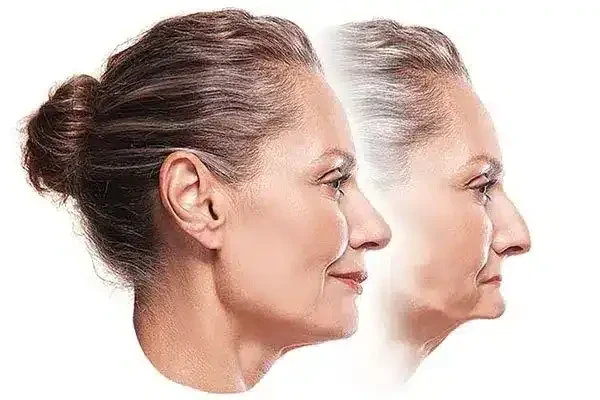 Pérdida de hueso maxilar por falta de dientes: cambio en el perfil facial