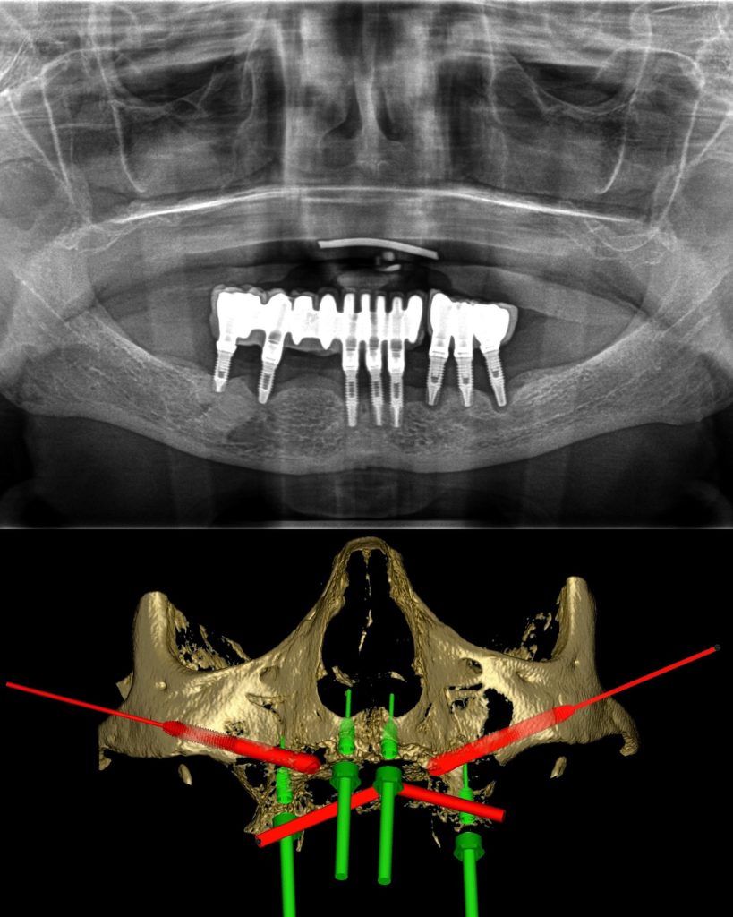 Planificación digital 3D de implantes cigomáticos sobre el TAC, por el Dr. Alejandro Prieto en MAG Dental Madrid