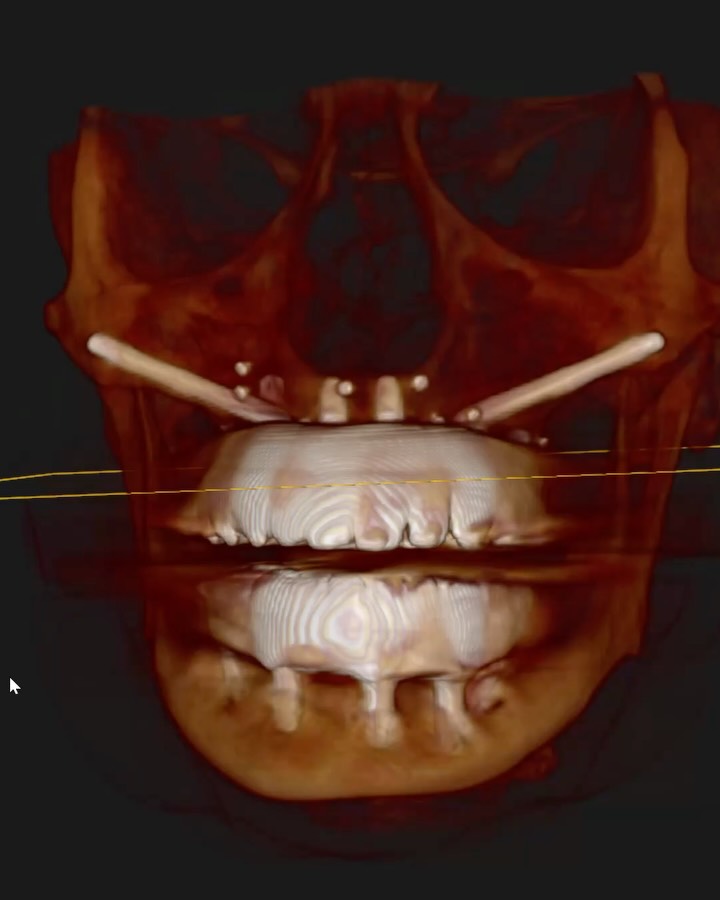 Planificación digital en 3D de implantes y prótesis sobre el TAC, por el Dr. Alejandro Prieto en MAG Dental Madrid