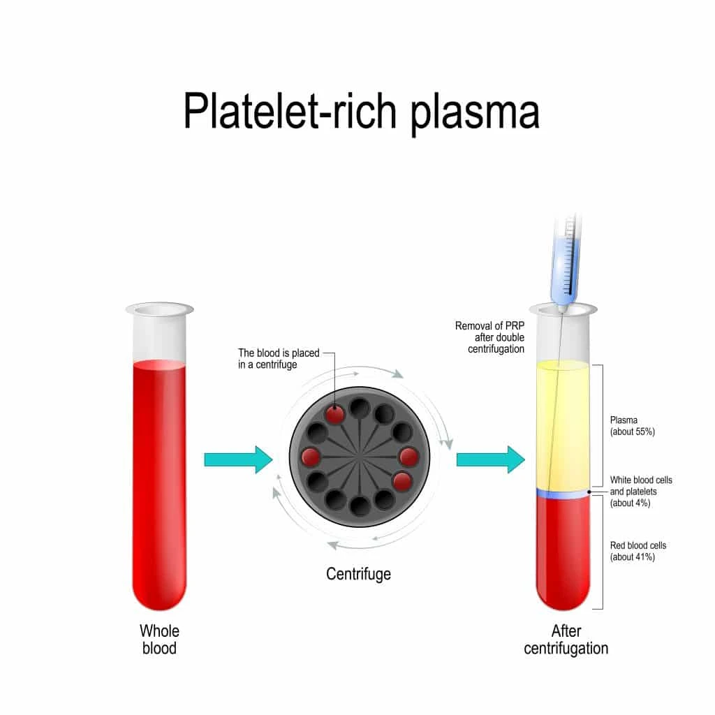 Obtención del plasma rico en plaquetas para el injerto de hueso dental