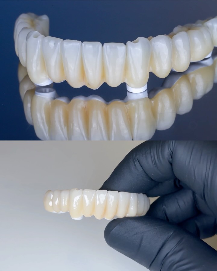 Prótesis All-on-4 con barra de zirconio sobre 4 implantes, por el Dr. Alejandro Prieto en MAG Dental Madrid
