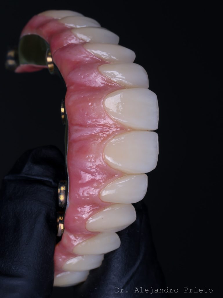 Prótesis fija superior para un maxilar atrófico sobre implantes pterigoideos, por el Dr. Alejandro Prieto en MAG Dental Madrid