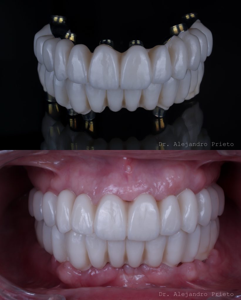 Prótesis fija de zirconio para boca completa sobre implantes (FP1) con carga inmediata, por el Dr. Alejandro Prieto en MAG Dental Madrid