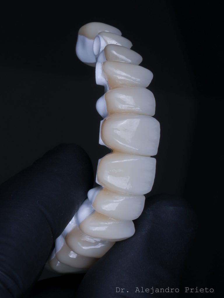 Prótesis full arch superior con barra de zirconio sobre implantes, por el Dr. Alejandro Prieto en MAG Dental Madrid