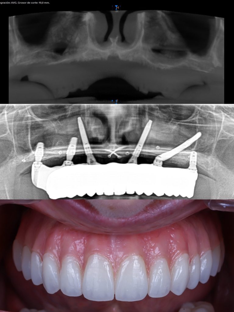 Radiografía antes y después: implantes cigomáticos y transnasales en un maxilar atrófico, por el Dr. Alejandro Prieto en MAG Dental Madrid