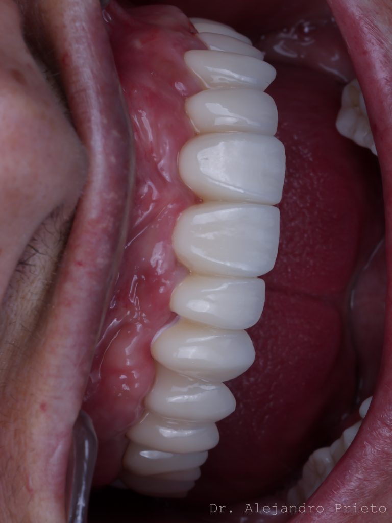 Vista lateral del resultado de una prótesis fija superior sobre implantes, por el Dr. Alejandro Prieto en MAG Dental Madrid