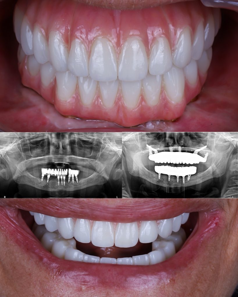 Retratamiento de implantes: antes y después de la sonrisa con radiografías, por el Dr. Alejandro Prieto en MAG Dental Madrid