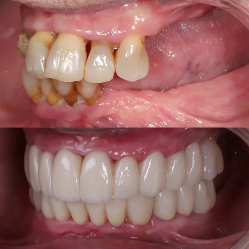 Testimonio de implantes sin hueso: antes y después con dientes fijos en MAG Dental Madrid